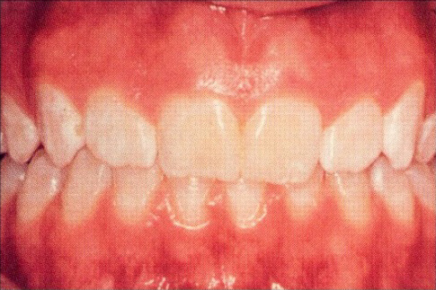 Patient teeth, before Gum Rejuvenation treatment, front view, patient 1 
