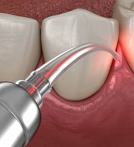 Periodontal therapy photo