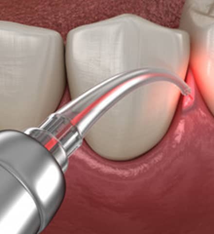 Periodontal therapy photo