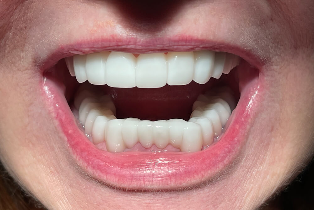 Patient teeth, after treatment, front view