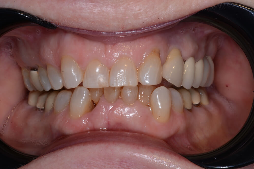 Patient teeth before treatment at Boca’s Leader in Periodontics (front view)
