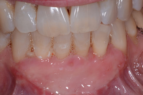 Patient teeth, after Gum Rejuvenation treatment, front view, patient 2
