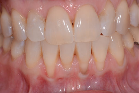 Patient teeth, before Gum Rejuvenation treatment, front view, patient 2