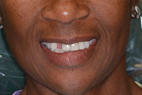 Multiple Tooth Replacement, before treatment photo, patient 1
