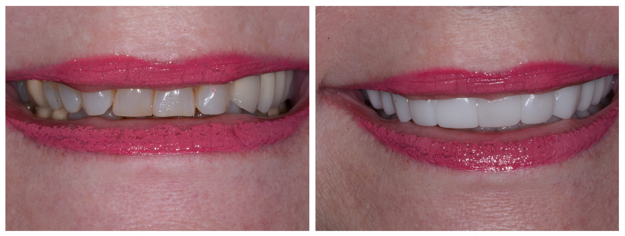 Smile Restoration - Before and After1