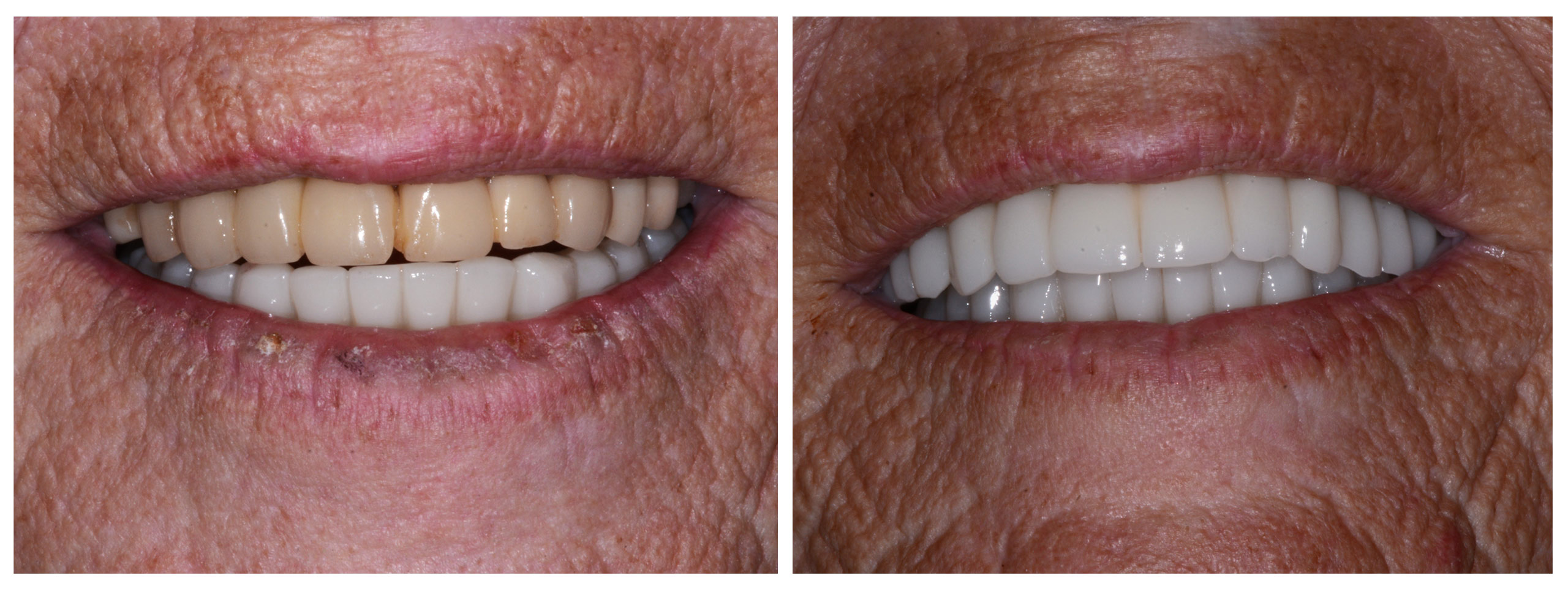 Smile Restoration - Before and After2