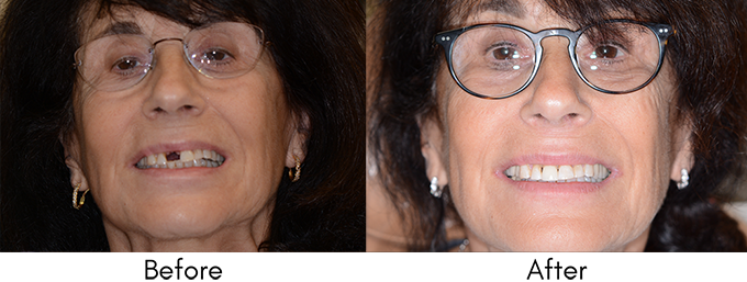 Dental Crowns - Before and After1
