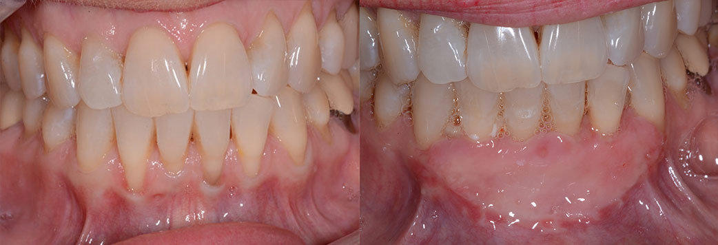 Gum Rejuvenation - Before and After1