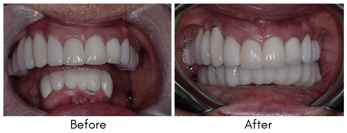 Smile Restoration - Before and After1