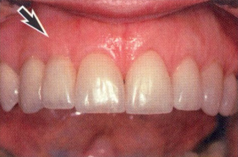 Patient teeth, after Gum Rejuvenation treatment, front view - patient 4