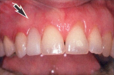 Patient teeth, before Gum Rejuvenation treatment, front view - patient 4