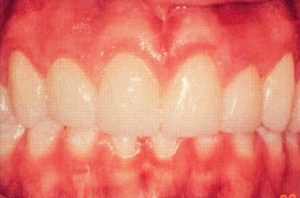 Patient teeth, after Gum Rejuvenation treatment, front view - patient 5