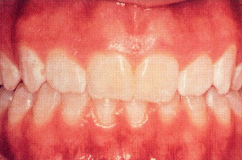 Patient teeth, before Gum Rejuvenation treatment, front view - patient 5