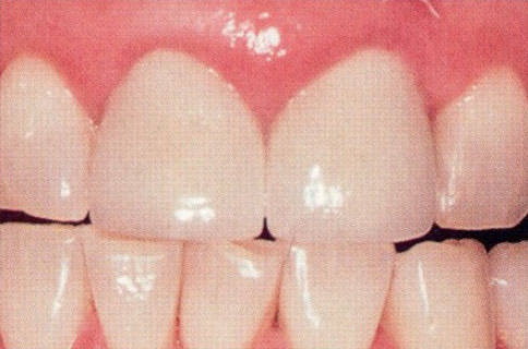 Patient teeth, after Gum Rejuvenation treatment, front view - patient 6