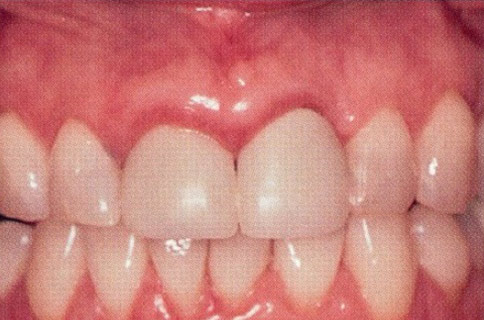 Patient teeth, before Gum Rejuvenation treatment, front view - patient 6