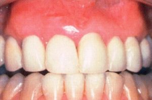 Patient teeth, after Gum Rejuvenation treatment, front view - patient 7