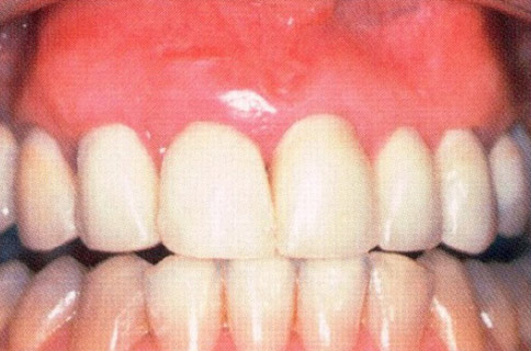 Patient teeth, after Gum Rejuvenation treatment, front view - patient 7