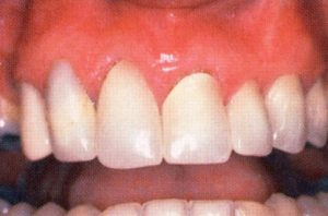Patient teeth, before Gum Rejuvenation treatment, front view - patient 7
