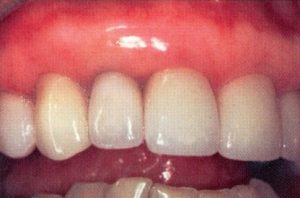 Patient teeth, after Gum Rejuvenation treatment, front view - patient 8