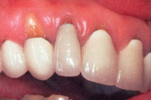 Patient teeth, before Gum Rejuvenation treatment, front view - patient 8