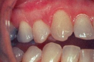 Patient teeth, after Gum Rejuvenation treatment, front view - patient 9