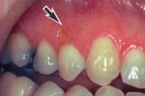 Patient teeth, before Gum Rejuvenation treatment, front view - patient 9