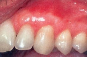 Patient teeth, after Gum Rejuvenation treatment, front view - patient 10
