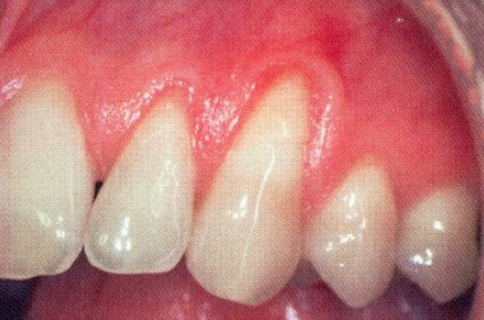 Patient teeth, before Gum Rejuvenation treatment, front view - patient 10