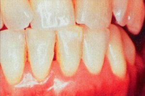 Patient teeth, after Gum Rejuvenation treatment, front view - patient 3
