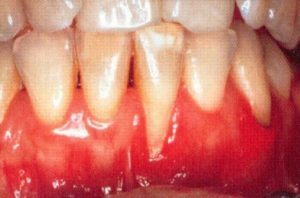 Patient teeth, before Gum Rejuvenation treatment, front view - patient 3