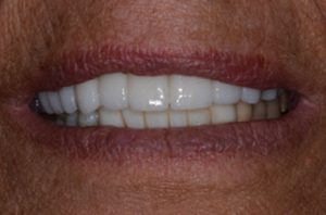 Patient teeth, after Dental Bridges treatment, front view - patient 1