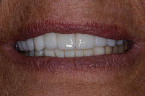 Patient teeth, after Dental Bridges treatment, front view - patient 1
