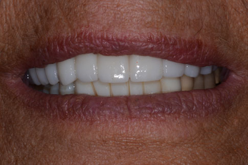 Complete Set of Implant-Supported Teeth, after treatment photo, patient 2