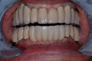 Patient teeth, before Dental Bridges treatment, front view - patient 1