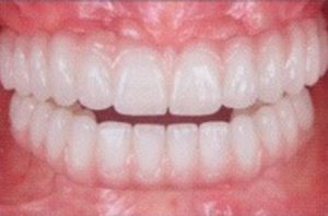 Patient teeth, after Dental Implants treatment, front view - patient 6