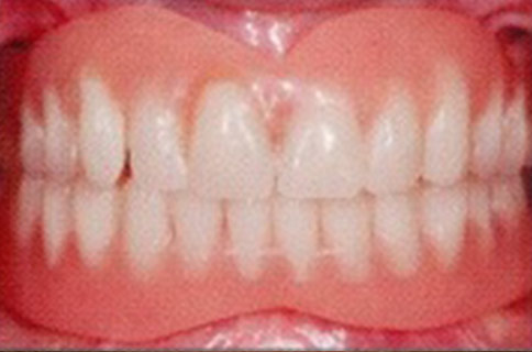 Patient teeth, before Dental Implants treatment, front view - patient 6