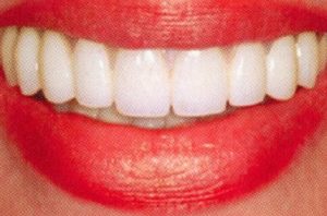 Patient teeth, after Dental Implants treatment, front view - patient 1