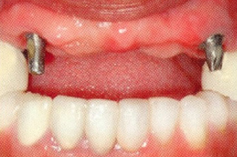 Patient teeth, before Dental Implants treatment, front view - patient 1
