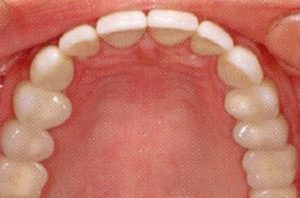 Patient teeth, after Dental Implants treatment, front view - patient 7