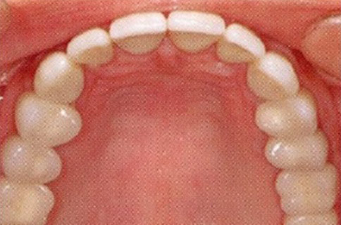 Patient teeth, after Dental Implants treatment, front view - patient 7