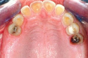 Patient teeth, before Dental Implants treatment, front view - patient 7