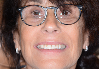 Woman’s teeth, after Dental Crowns treatment, front view - patient 5