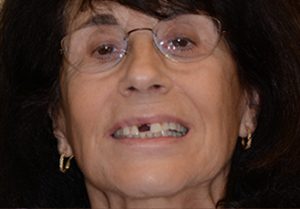 Woman’s teeth, before Dental Crowns treatment, front view - patient 5