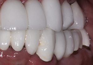 Patient teeth, after Dental Crowns treatment, front view - patient 4
