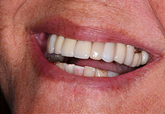 Patient teeth, after Dental Crowns treatment, front view - patient 3