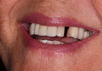 Patient teeth, before Dental Crowns treatment, front view - patient 3