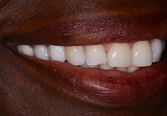 Patient teeth, after Dental Crowns treatment, front view - patient 2