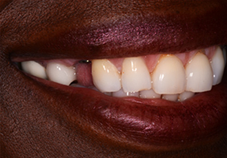 Patient teeth, before Dental Crowns treatment, front view - patient 2