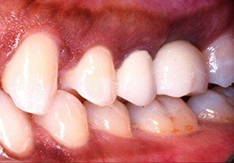 Patient teeth, after Dental Crowns treatment, front view - patient 1