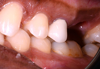 Patient teeth, before Dental Crowns treatment, front view - patient 1